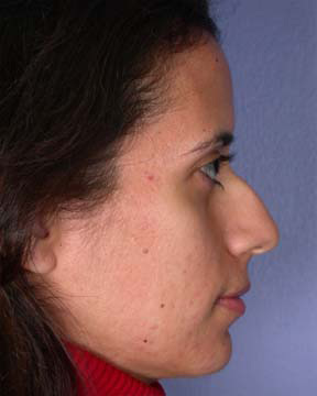 Nose Reshaping before and after photo