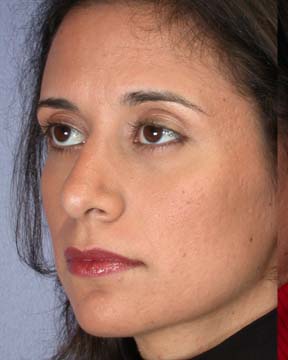 Nose Reshaping before and after photo