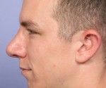 Nose Reshaping Before and after photo