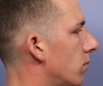 Nose Reshaping Before and after photo