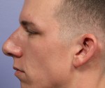 Nose Reshaping Before and after photo