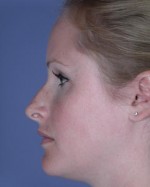 Nose Reshaping Before and after photo