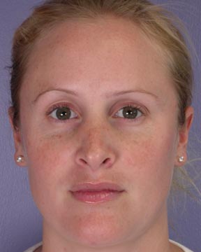 Nose Reshaping before and after photo