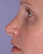 Nose Reshaping