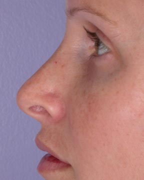 Nose Reshaping before and after photo