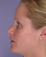 Nose Reshaping Before and after photo