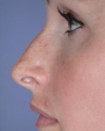 Nose Reshaping Before and after photo