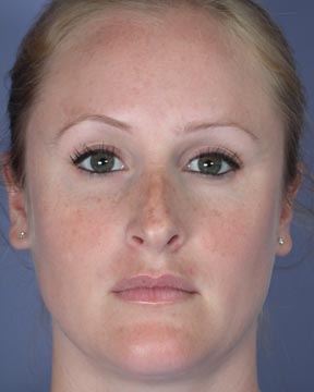 Nose Reshaping before and after photo