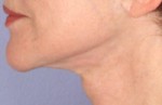 ThermaCool Non-Surgical Facelift