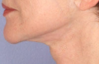 ThermaCool Non-Surgical Facelift before and after photo