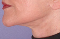 ThermaCool Non-Surgical Facelift before and after photo