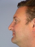 Nose Reshaping Before and after photo