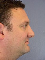 Nose Reshaping Before and after photo