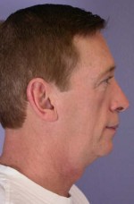 ThermaCool Non-Surgical Facelift Before and after photo