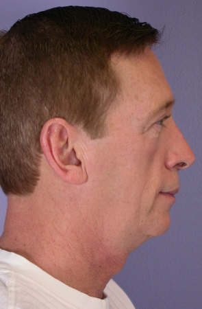 ThermaCool Non-Surgical Facelift before and after photo