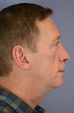 ThermaCool Non-Surgical Facelift Before and after photo