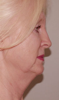 ThermaCool Non-Surgical Facelift before and after photo