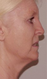 ThermaCool Non-Surgical Facelift Before and after photo