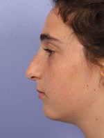 Nose Reshaping Before and after photo