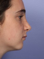 Nose Reshaping Before and after photo