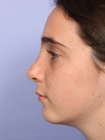 Nose Reshaping Before and after photo