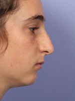 Nose Reshaping Before and after photo