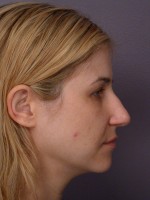 Nose Reshaping Before and after photo