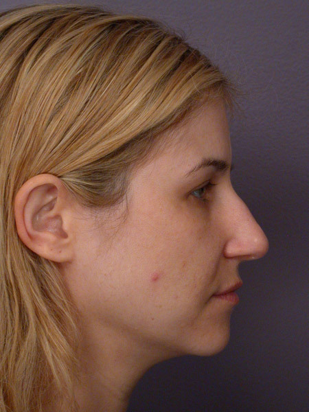 Nose Reshaping before and after photo