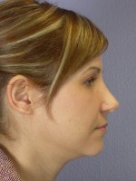 Nose Reshaping Before and after photo