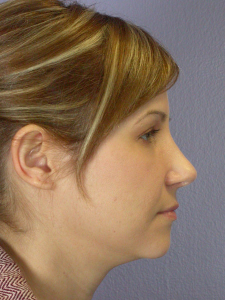 Nose Reshaping before and after photo