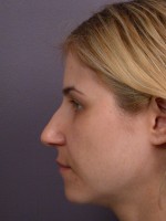 Nose Reshaping Before and after photo