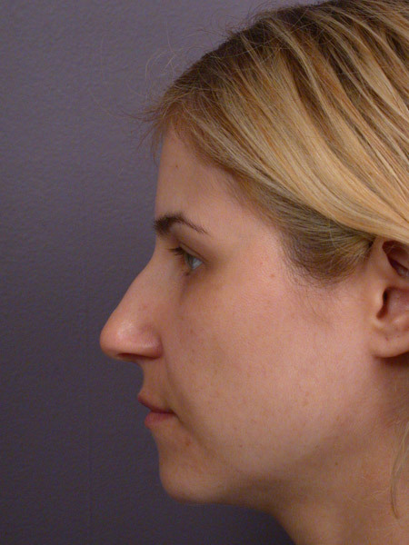 Nose Reshaping before and after photo