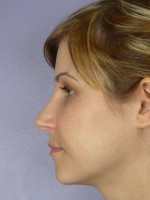 Nose Reshaping Before and after photo