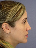 Nose Reshaping Before and after photo