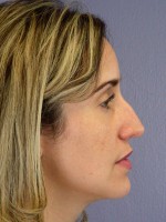 Nose Reshaping Before and after photo