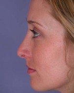 Nose Reshaping Before and after photo