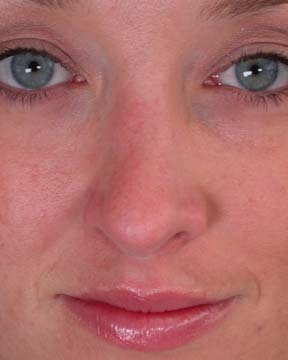 Nose Reshaping before and after photo