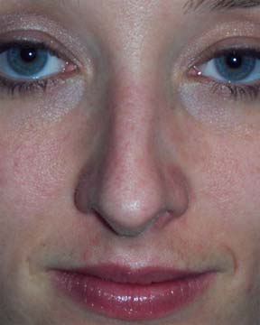 Nose Reshaping before and after photo