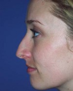 Nose Reshaping Before and after photo