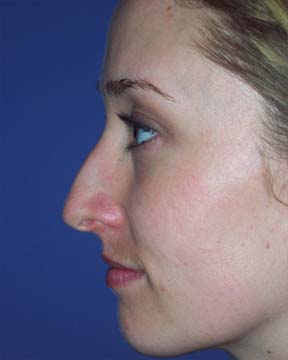 Nose Reshaping before and after photo