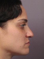 Nose Reshaping Before and after photo