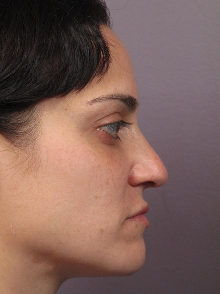 Nose Reshaping before and after photo