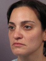 Nose Reshaping Before and after photo