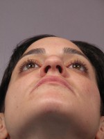 Nose Reshaping Before and after photo