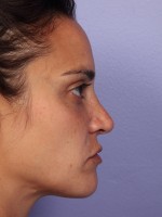 Nose Reshaping Before and after photo