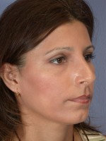 Nose Reshaping Before and after photo