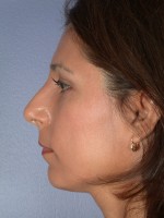 Nose Reshaping Before and after photo