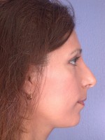 Nose Reshaping Before and after photo