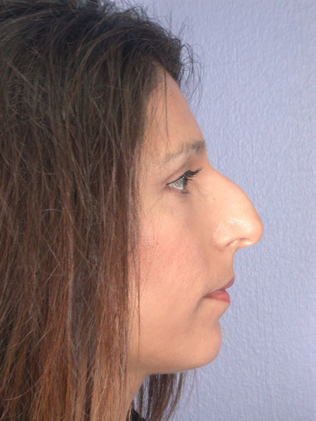 Nose Reshaping before and after photo