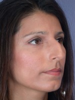 Nose Reshaping